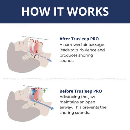 Trusleep Anti-Snoring PRO Kit